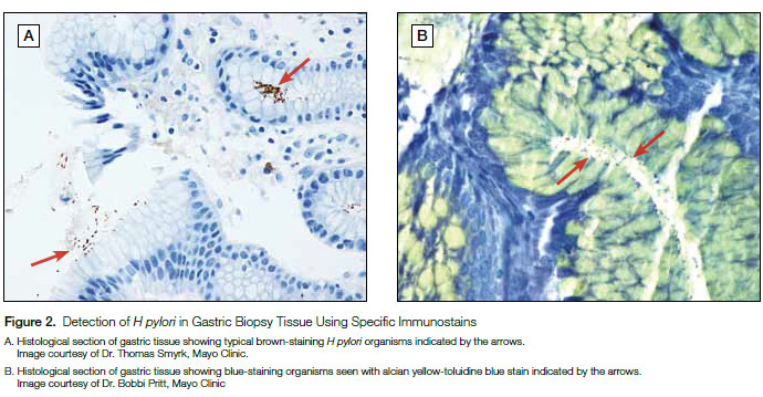 Figure 2. Detection of H pylori in Gastric Biopsy Tissue Using Specific Immunostains